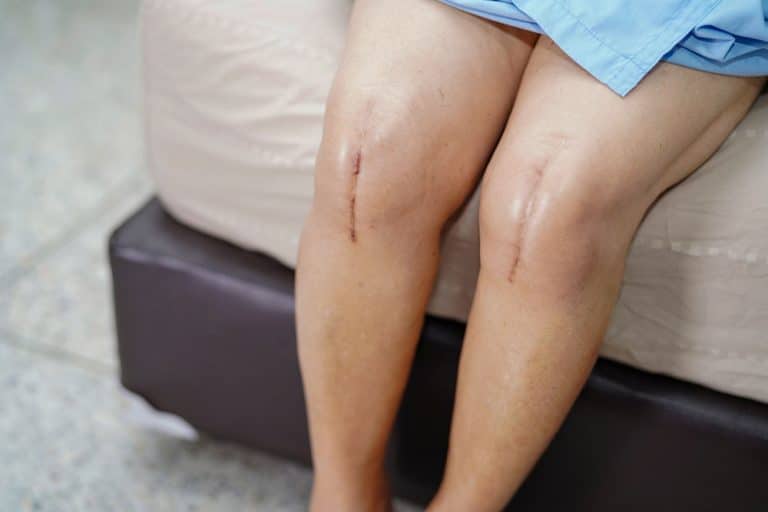 Scar Desensitization Chiropractor Chicago Scar Management and